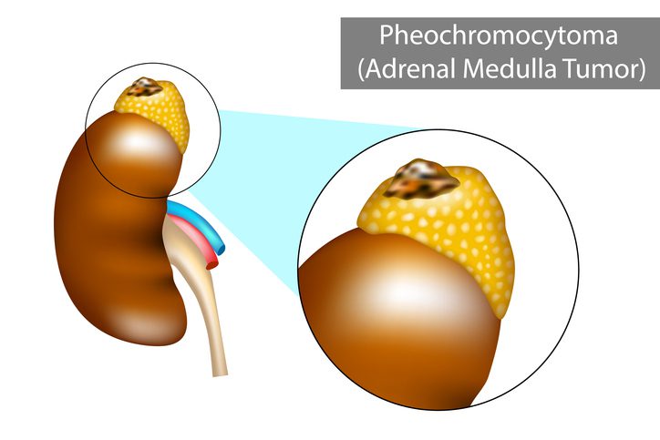 Pheochromocytoma - important and rare cause of secondary diabetes